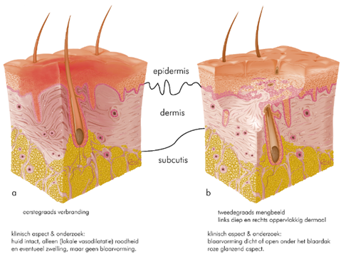 Huid bij tweede- en derdegraads verbrandingen